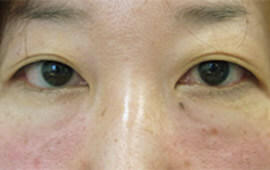 30代女性の目の下のクマ治療 After 症例写真