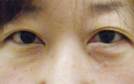 30代女性の目の下のクマ治療 Before 症例写真