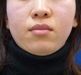 30代女性のサーマクール Before 症例写真