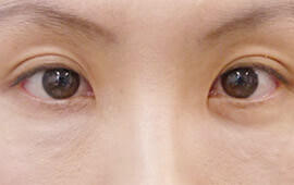 30代女性の目の下のクマ治療 After 症例写真