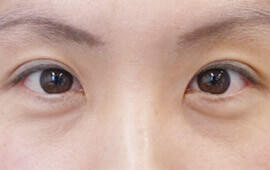 30代女性の目の下のクマ治療 Before 症例写真