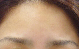 30代女性のシワ・たるみ After 症例写真