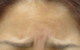 30代女性のシワ・たるみ Before 症例写真