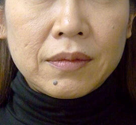 40代女性のヒアルロン酸注射（ほうれい線） Before 症例写真