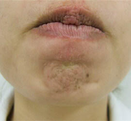 30代女性のボトックス（シワ取り） Before 症例写真