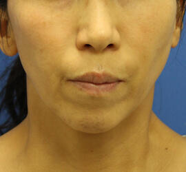 50代女性の After 症例写真