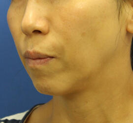 50代女性の After 症例写真