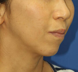 50代女性のシワ・たるみ After 症例写真