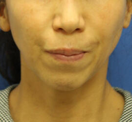 50代女性の Before 症例写真