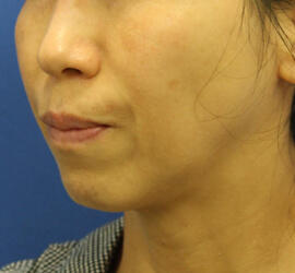 50代女性の Before 症例写真