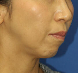 50代女性のシワ・たるみ Before 症例写真