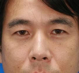30代男性のサーマクール After 症例写真