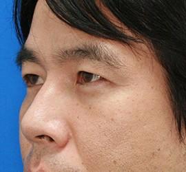 30代男性の目の下の脱脂  After 症例写真