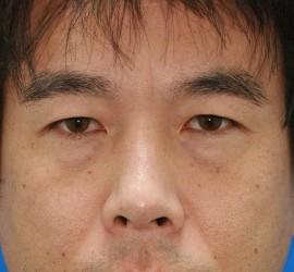 30代男性のサーマクール Before 症例写真