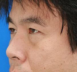 30代男性の目の下の脱脂  Before 症例写真