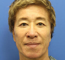 50代男性のシワ・たるみ After 症例写真