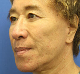 50代男性の下まぶたのたるみ取り After 症例写真