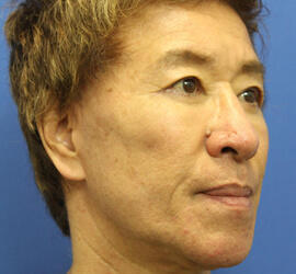 50代男性の下まぶたのたるみ取り After 症例写真