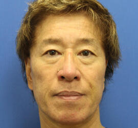 50代男性のシワ・たるみ Before 症例写真