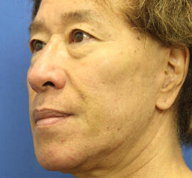 50代男性の下まぶたのたるみ取り Before 症例写真