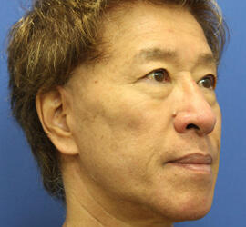 50代男性の下まぶたのたるみ取り Before 症例写真