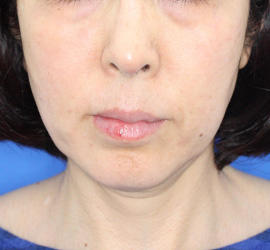 40代女性のサーマクール Before 症例写真