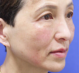 60代女性の目の下のクマ治療 After 症例写真