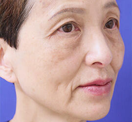 60代女性の目の下のクマ治療 Before 症例写真