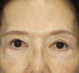 60代女性の眼瞼下垂 After 症例写真