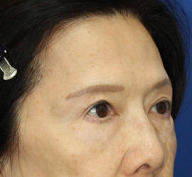 60代女性の眉下切開法 After 症例写真