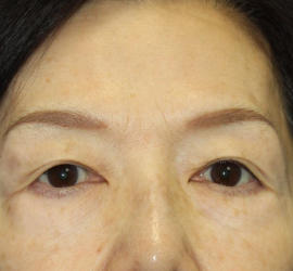 60代女性の眼瞼下垂 Before 症例写真