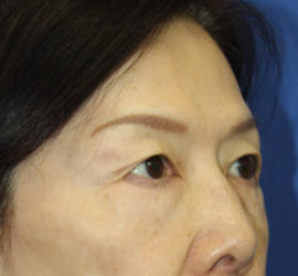 60代女性の眉下切開法 Before 症例写真