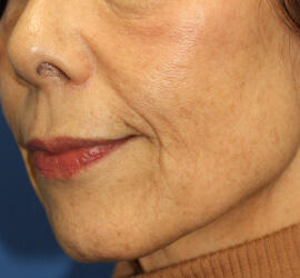 60代女性のシワ・たるみ After 症例写真