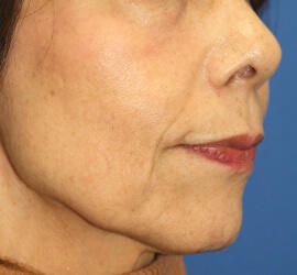 60代女性の After 症例写真