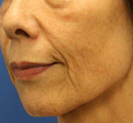 60代女性のシワ・たるみ Before 症例写真