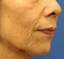 60代女性の Before 症例写真