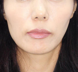 50代女性のサーマクール Before 症例写真