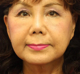 60代女性の After 症例写真