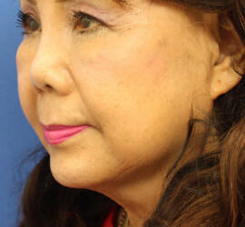 60代女性のシワ・たるみ After 症例写真