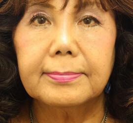 60代女性の Before 症例写真