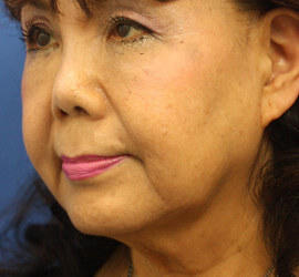 60代女性のシワ・たるみ Before 症例写真