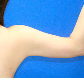 40代女性の脂肪吸引 After 症例写真