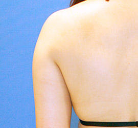 40代女性の脂肪吸引 Before 症例写真