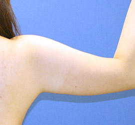 40代女性の脂肪吸引 Before 症例写真