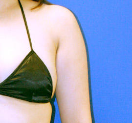 40代女性の脂肪吸引 Before 症例写真