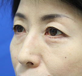 50代女性の下まぶたのたるみ取り Before 症例写真