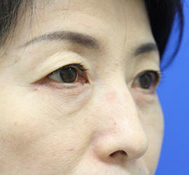 50代女性の下まぶたのたるみ取り After 症例写真