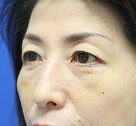 50代女性の下まぶたのたるみ取り Before 症例写真