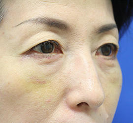 50代女性の下まぶたのたるみ取り After 症例写真