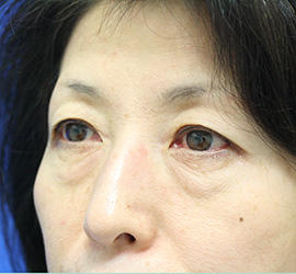 50代女性の下まぶたのたるみ取り Before 症例写真